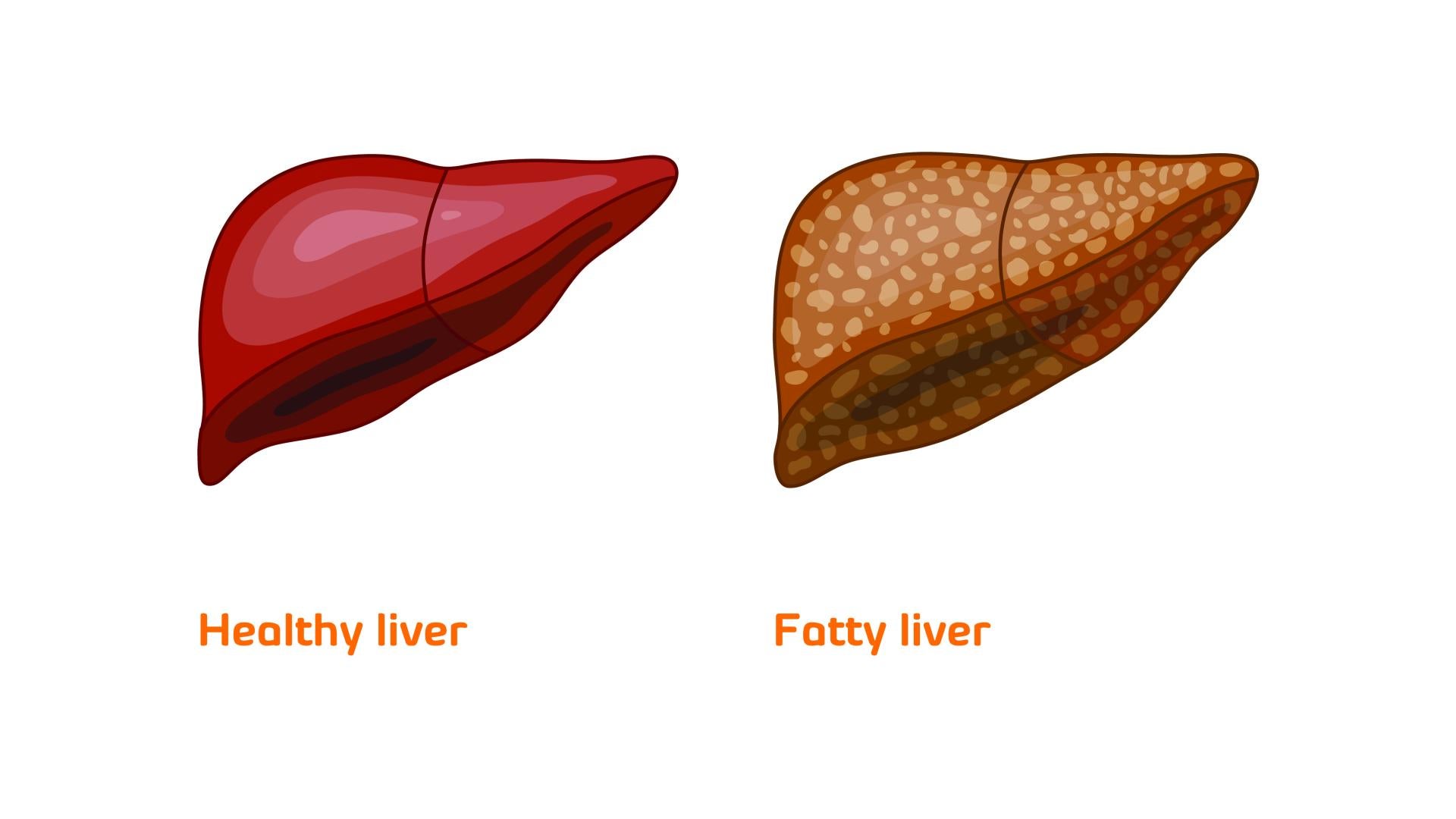 EN_FegatoTirosinemia-01